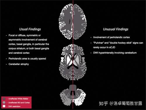 朊病毒大脑解剖图片图片