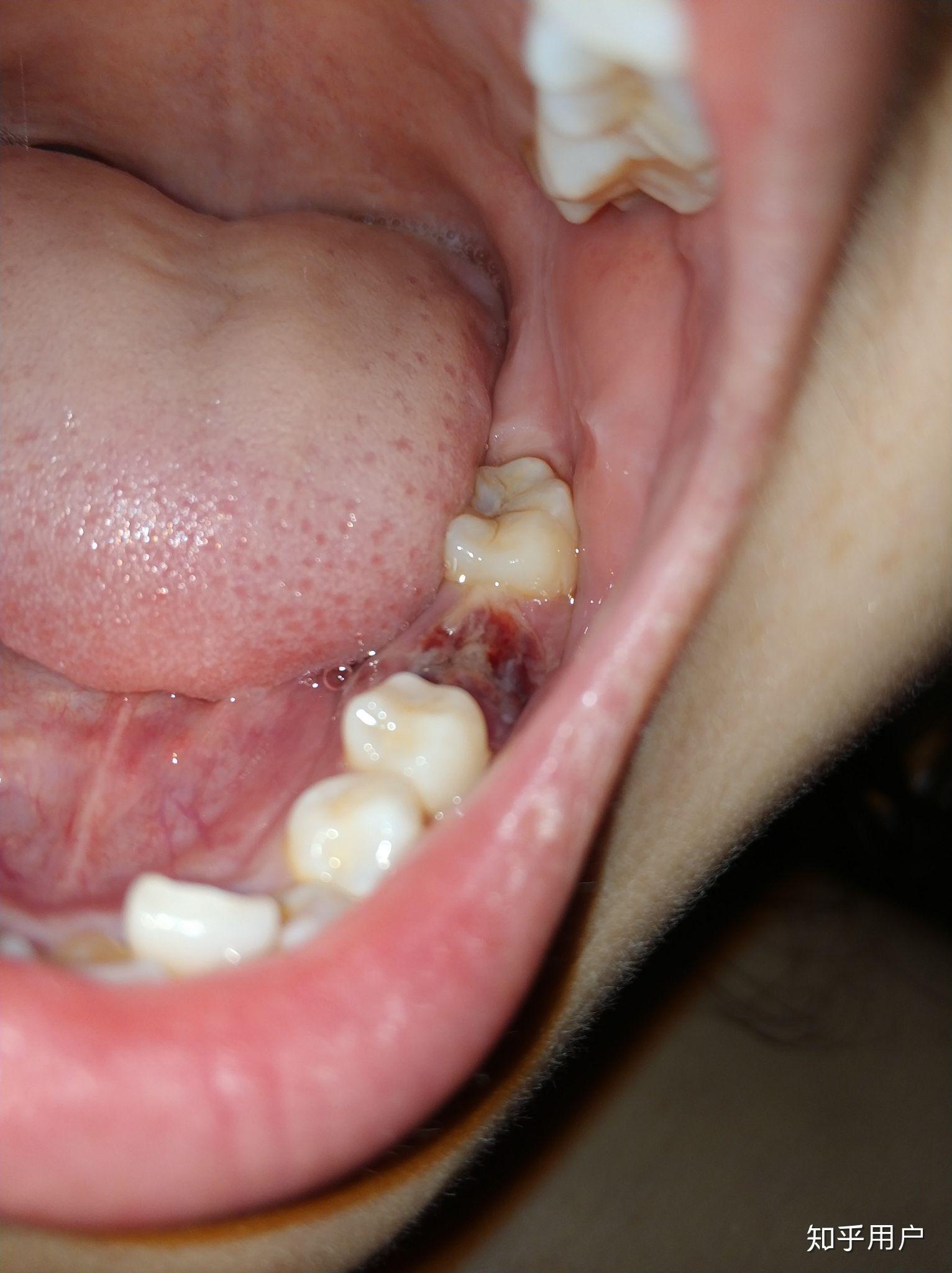 拔牙15天后牙窝状态图图片