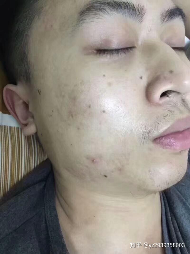 为什么你的痘痘反复长不停,因为你的痘根没拔除!护肤老师叶子 - 知乎