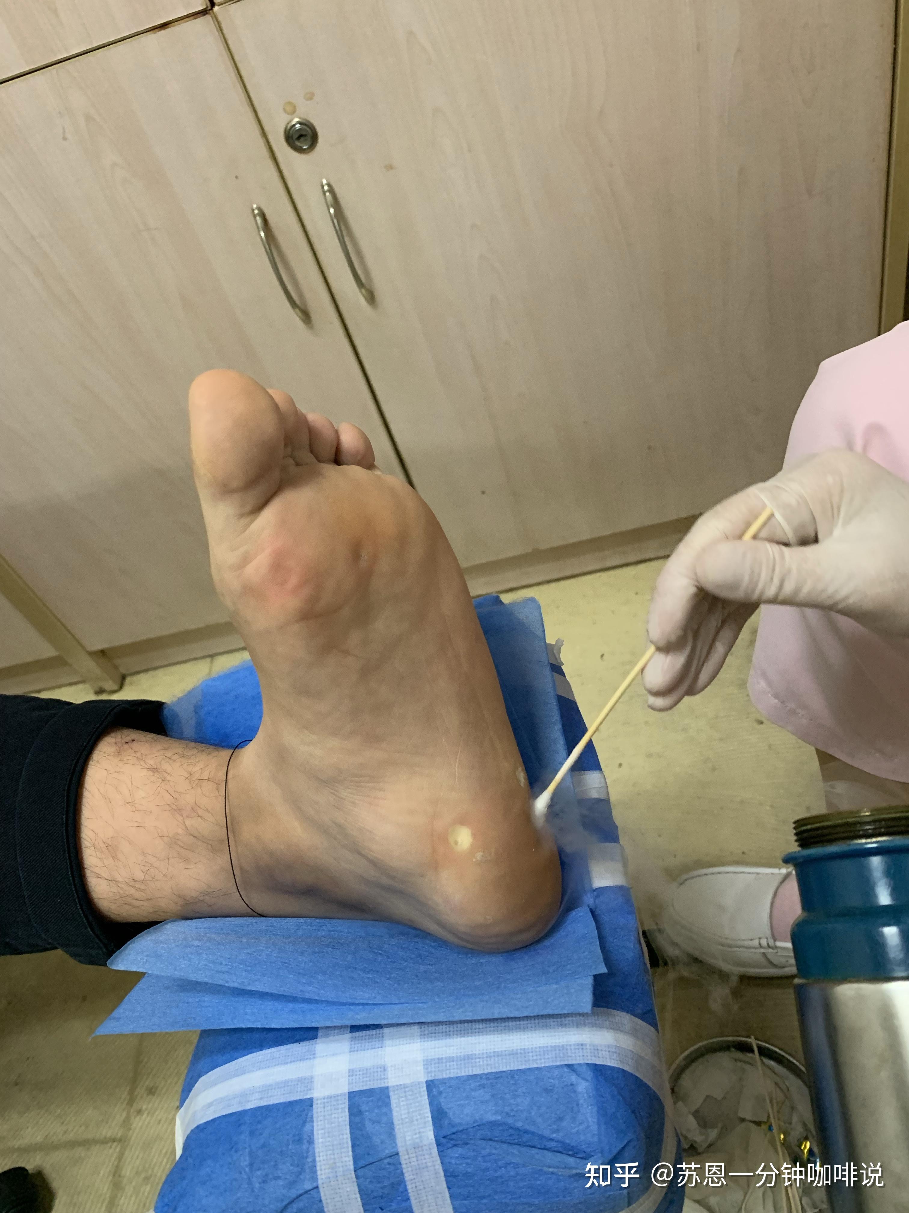 液氮冷冻治疗后手指上出了血泡而且越来越大该怎么办? - 知乎