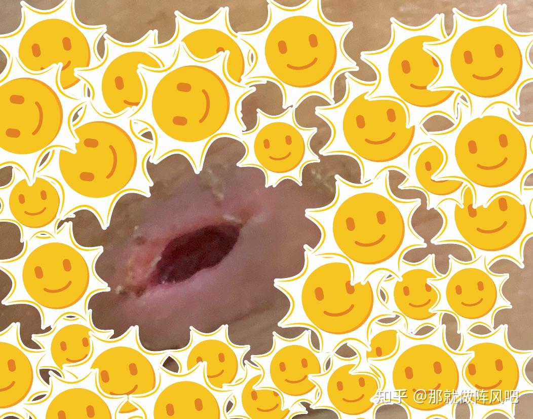 屁股上长个火疖子是什么感受