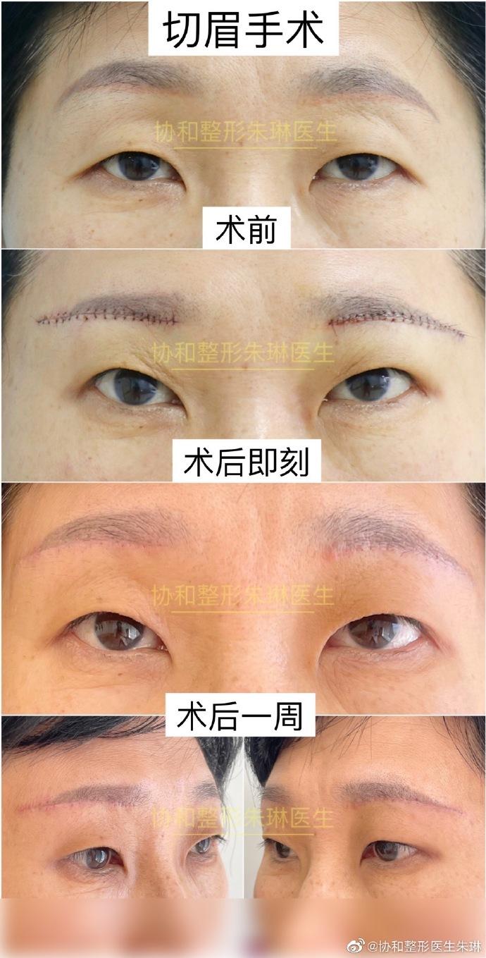 切眉术后1周眼部年轻化抗衰效果立现