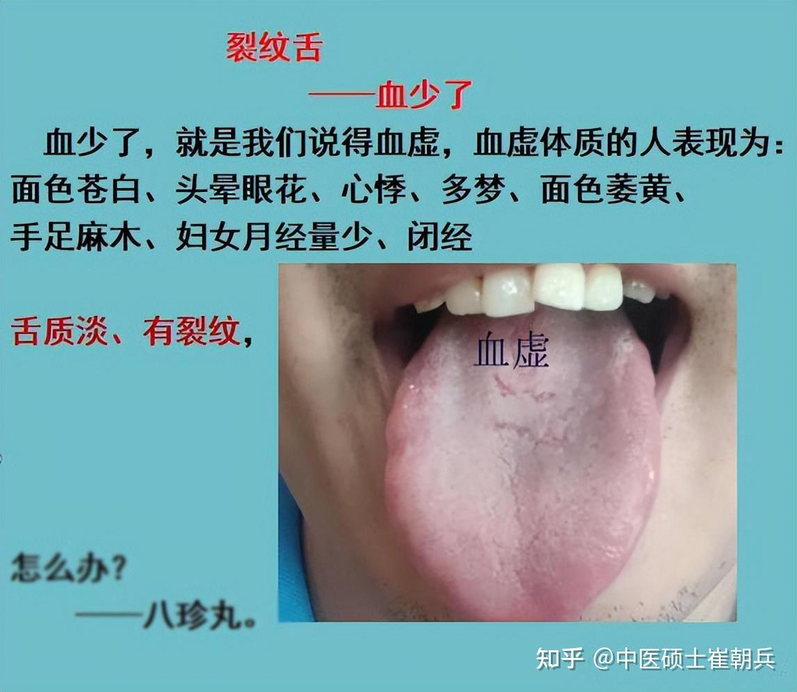 舌头有裂纹?5种原因,9种舌象,看看你是属于哪一种? - 知乎