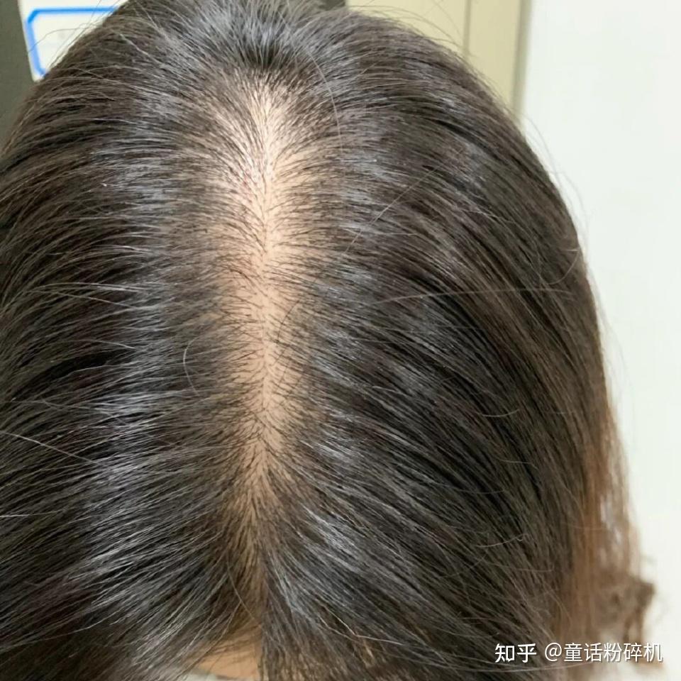 如何快速增加发量? - 知乎