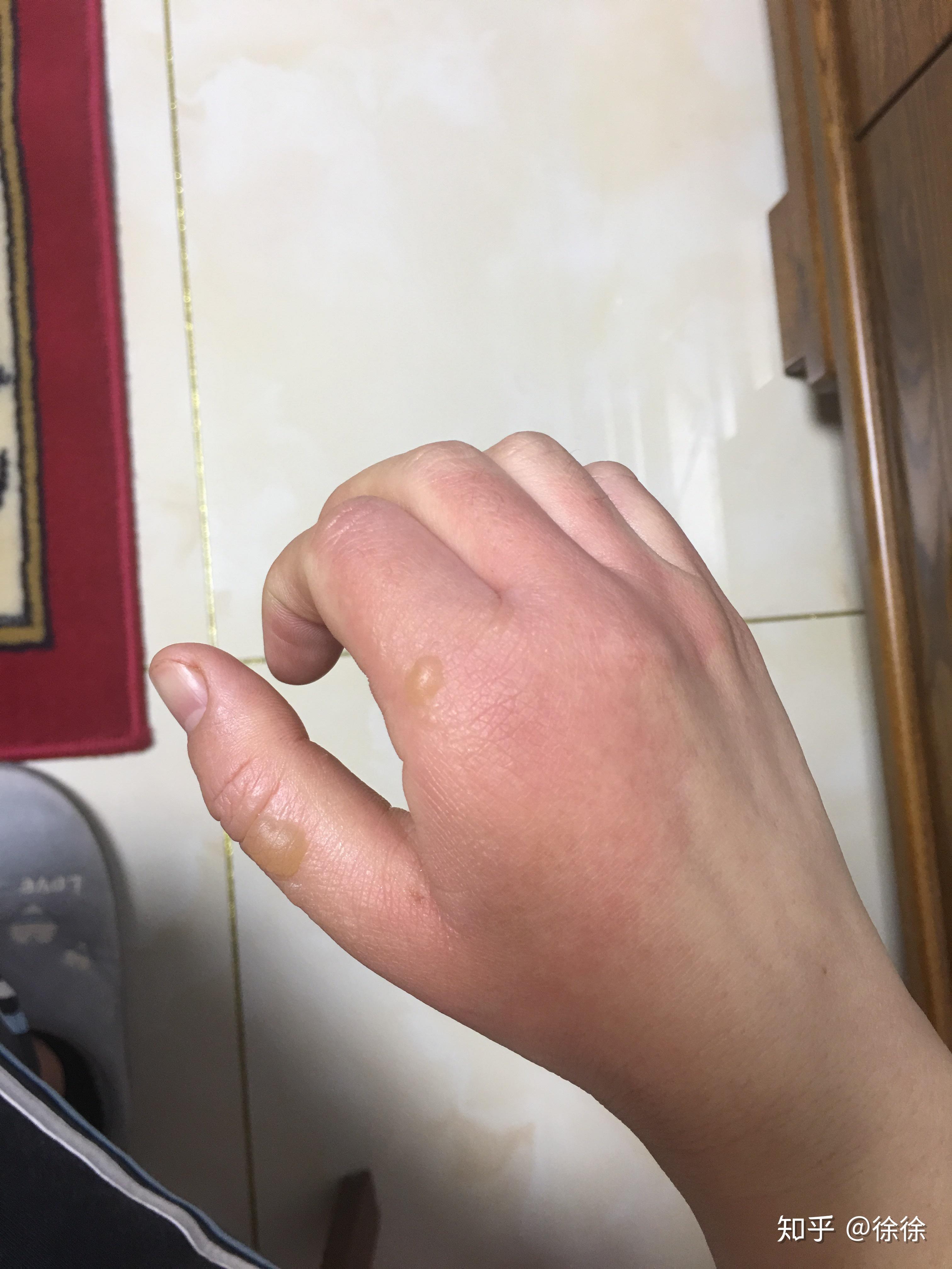 烫伤起的水泡可以戳破吗? - 知乎