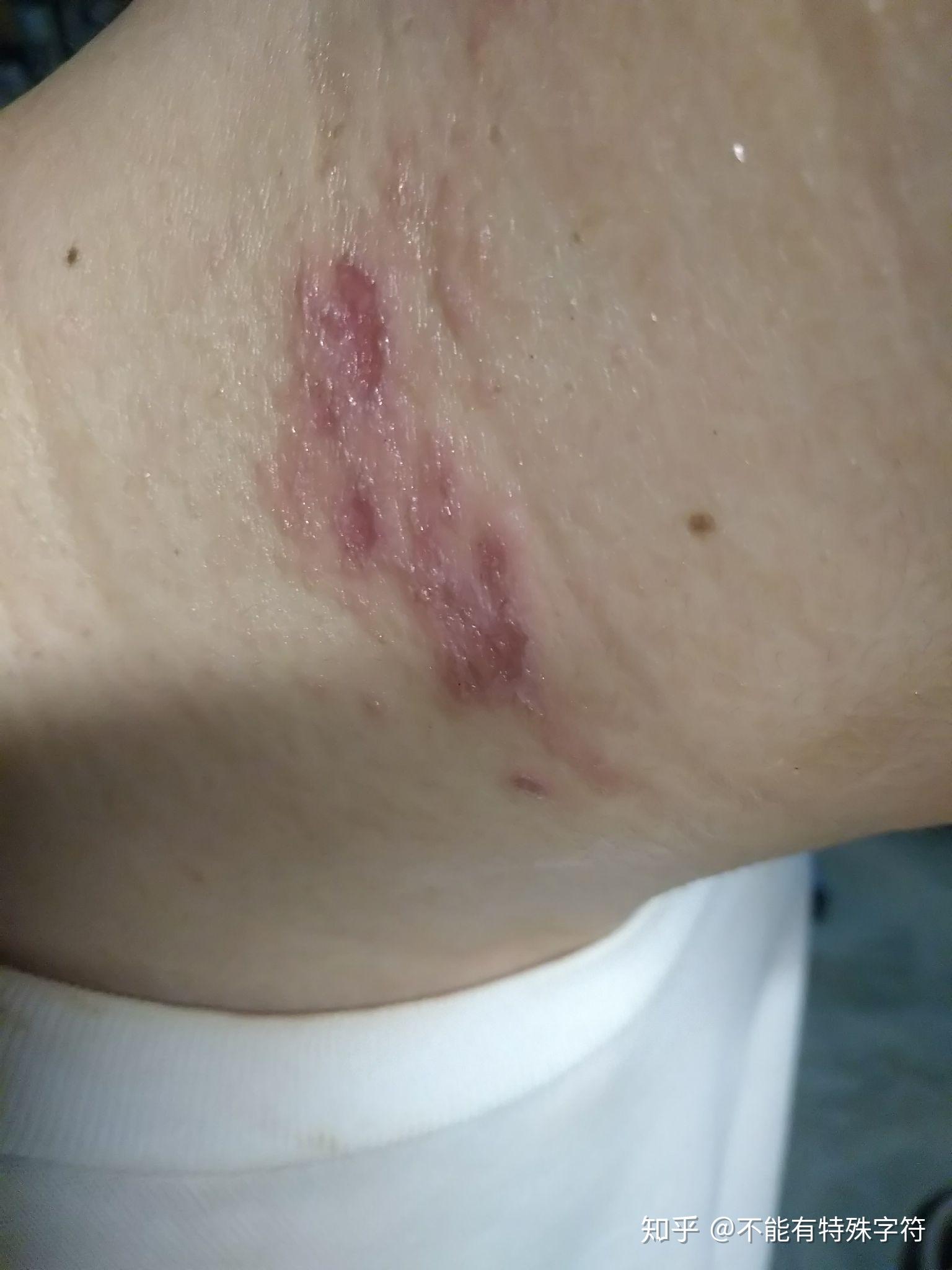 隐翅虫叮咬如何治疗