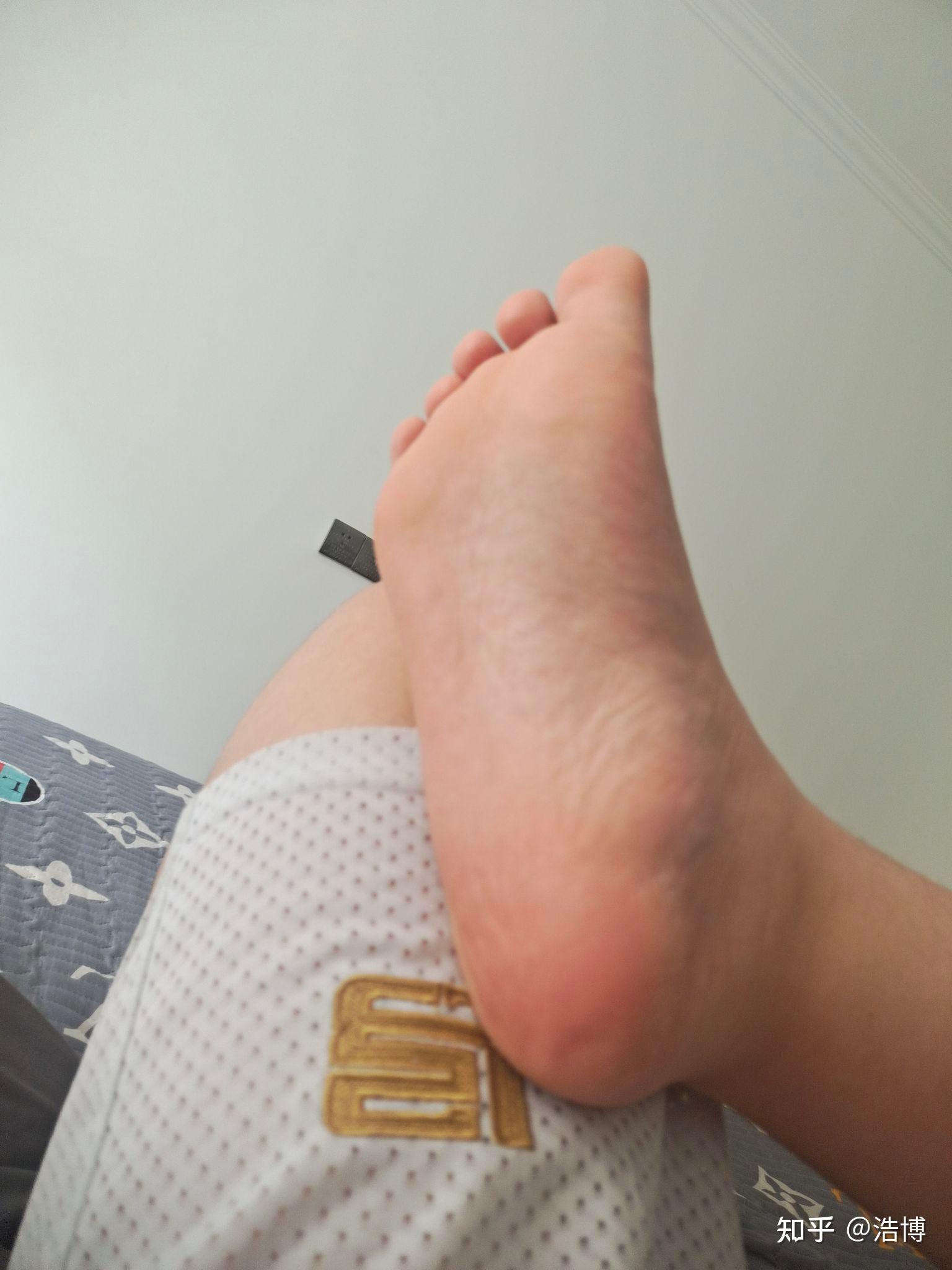 正常人脚后跟是什么颜色? - 知乎