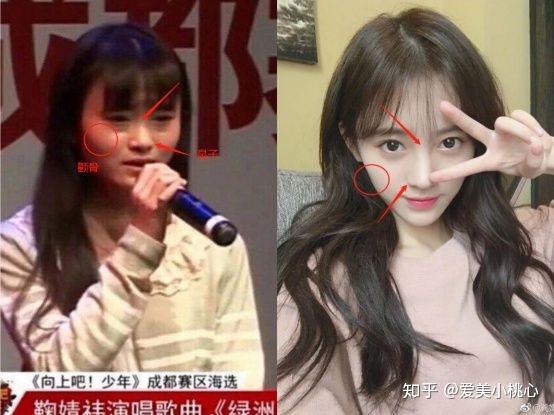 鞠婧祎到底整容了没有?