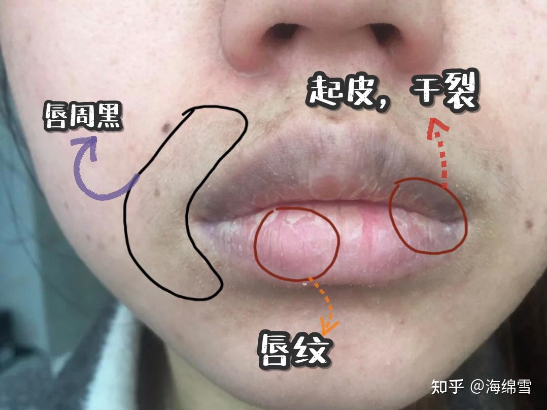 嘴角黑色素沉淀怎么去除求方法谢谢