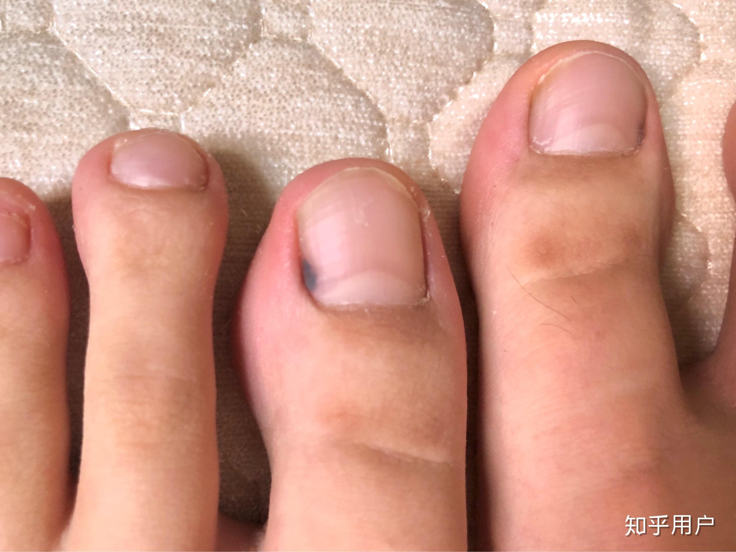 脚指甲里面有黑点点图片