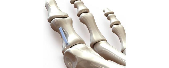 2019年骨水泥的市场规模达到581亿美元