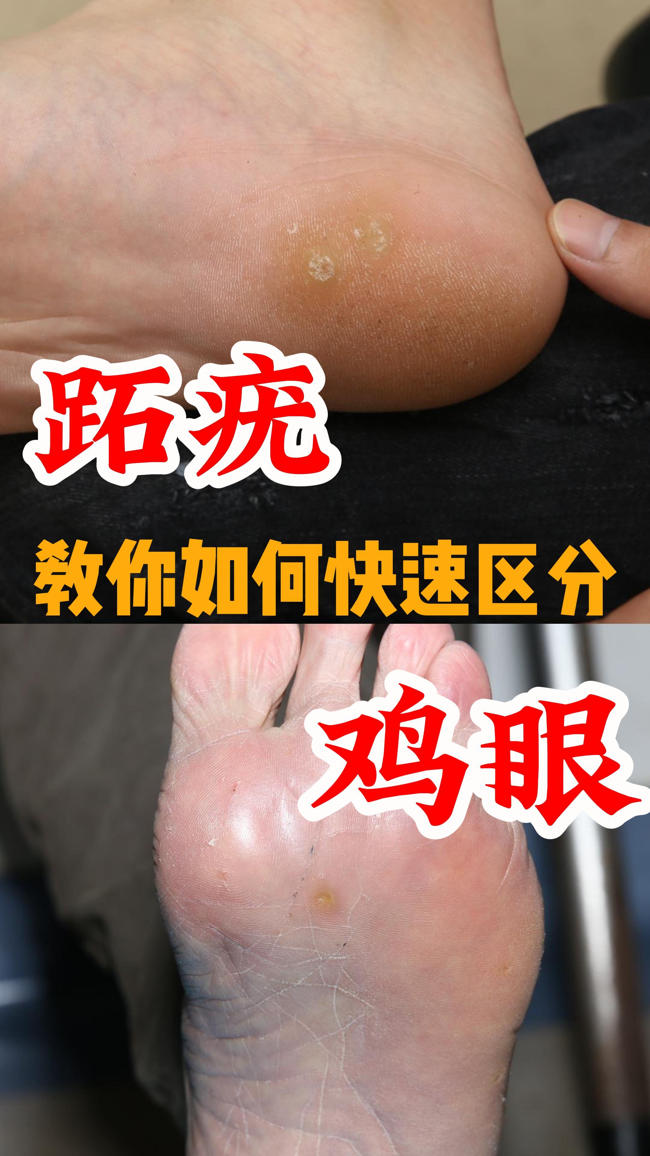 跖疣鸡眼教你快速区分