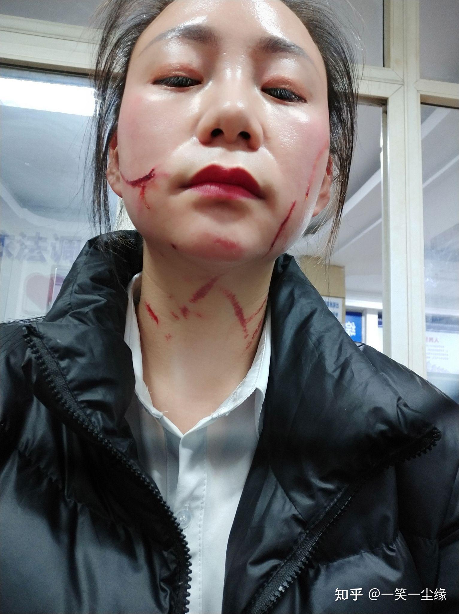 脸上被人抓了刮掉几块肉怎么处理才能快速痊愈且不留疤痕