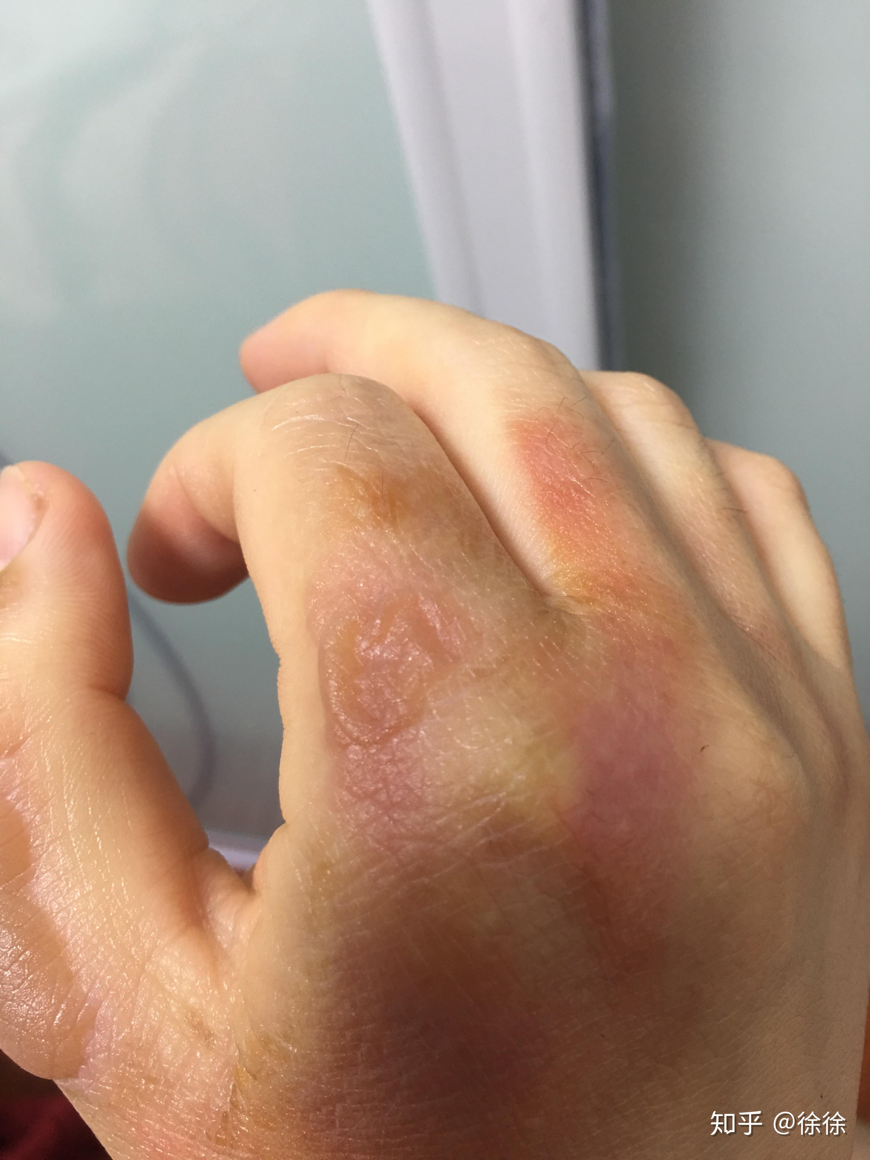 烫伤起的水泡可以戳破吗?