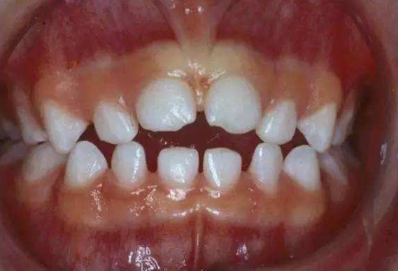 轻度开颌如何矫正? - 知乎