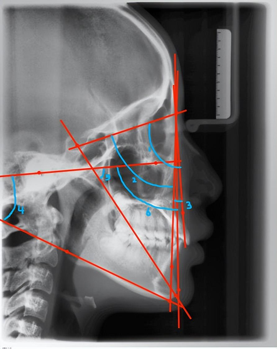 头影测量哪些指标可以确定是牙性或骨性突出? - 知乎