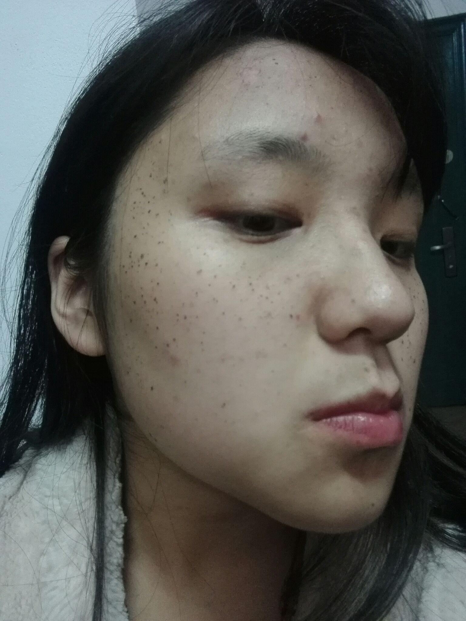 求高人指点 治疗遗传性雀斑的最佳方法 激光?光子? - 知乎