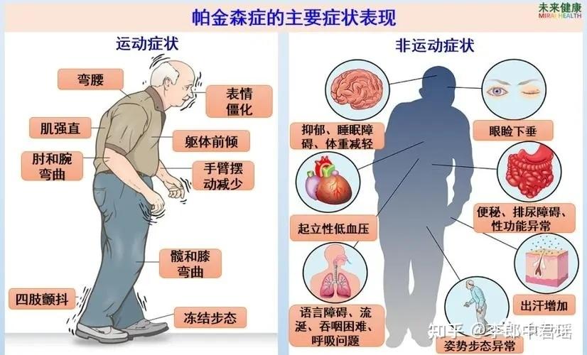 年轻人也开始得「帕金森病」,与遗传因素密切相关,年轻人出现哪些症状需警惕?如何预防帕金森病? - 知乎