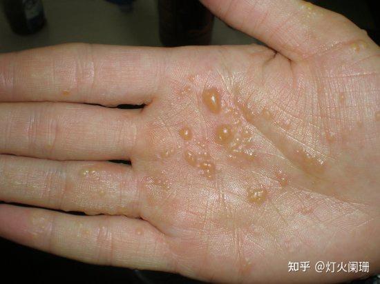 汗疱疹和手足癣到底怎么辨别? - 知乎