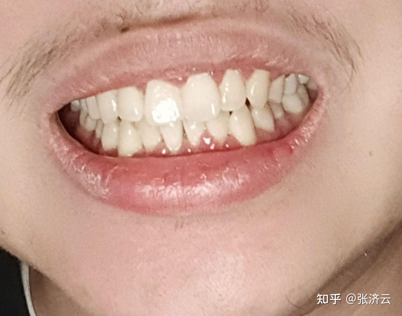 有人做过龈下刮治吗