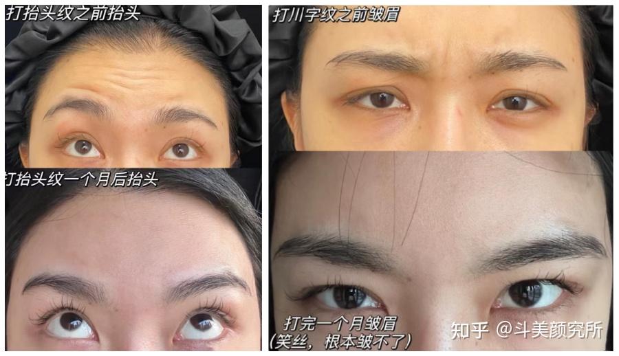 面部颜值“纹”题 | 静态纹和动态纹傻傻分不清楚？这篇文章帮你轻松搞定！ - 知乎
