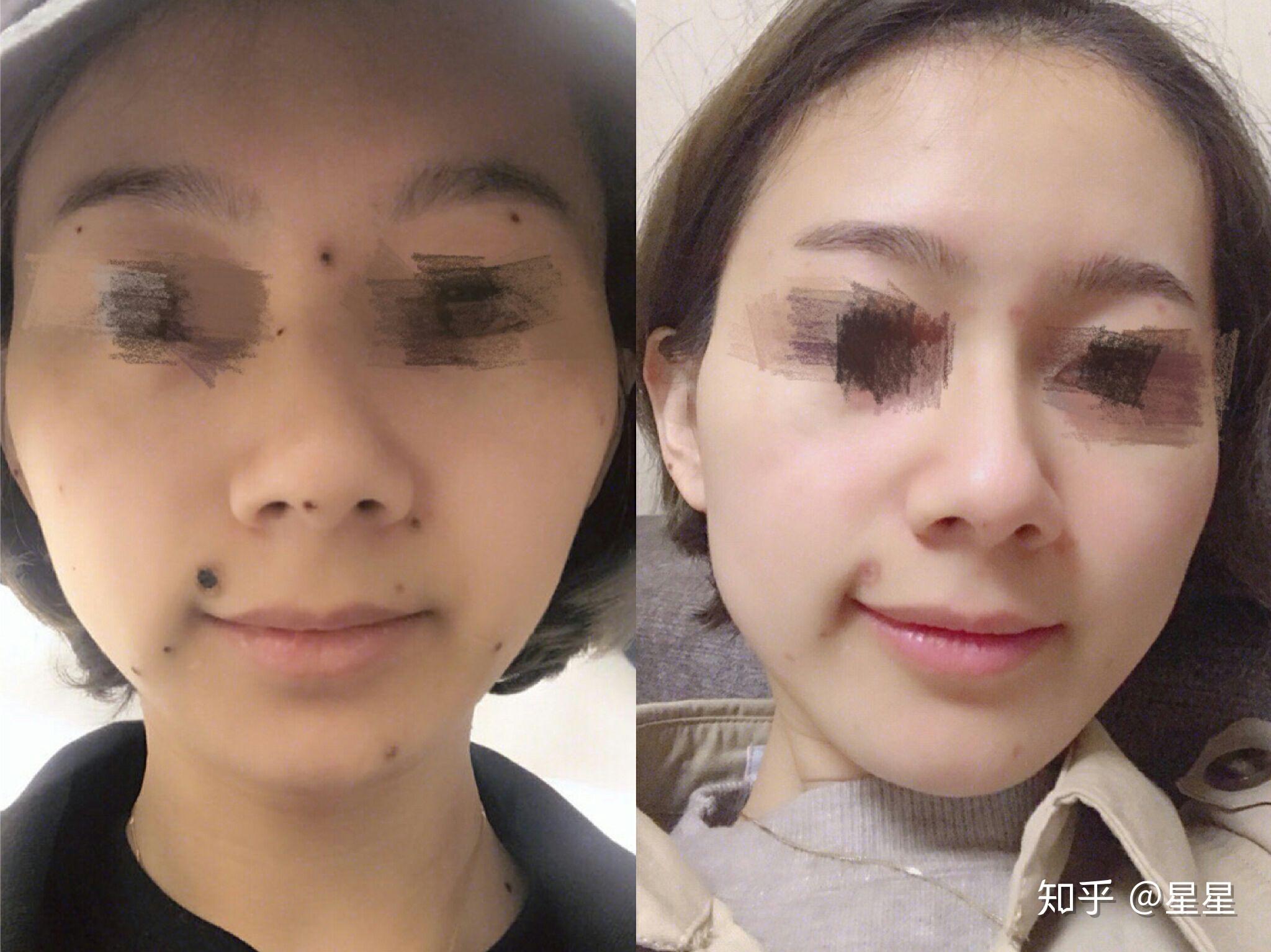 激光点痣和药水点痣那个比较安全?