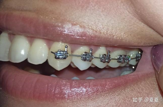 对颌牙伸长怎么办呐