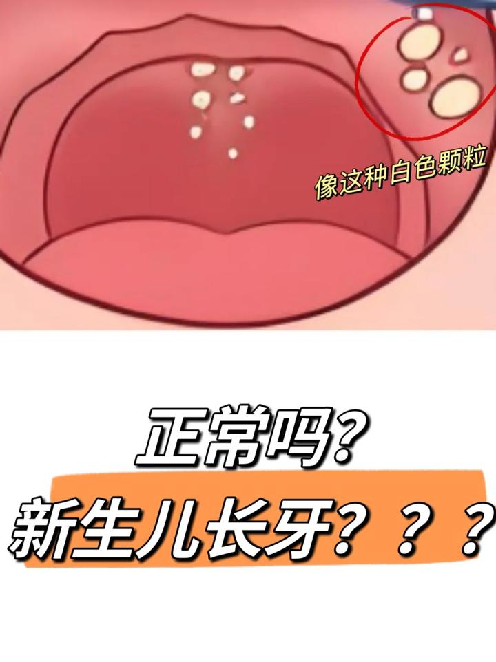 小象宝宝 有些新生儿的上颚中线和