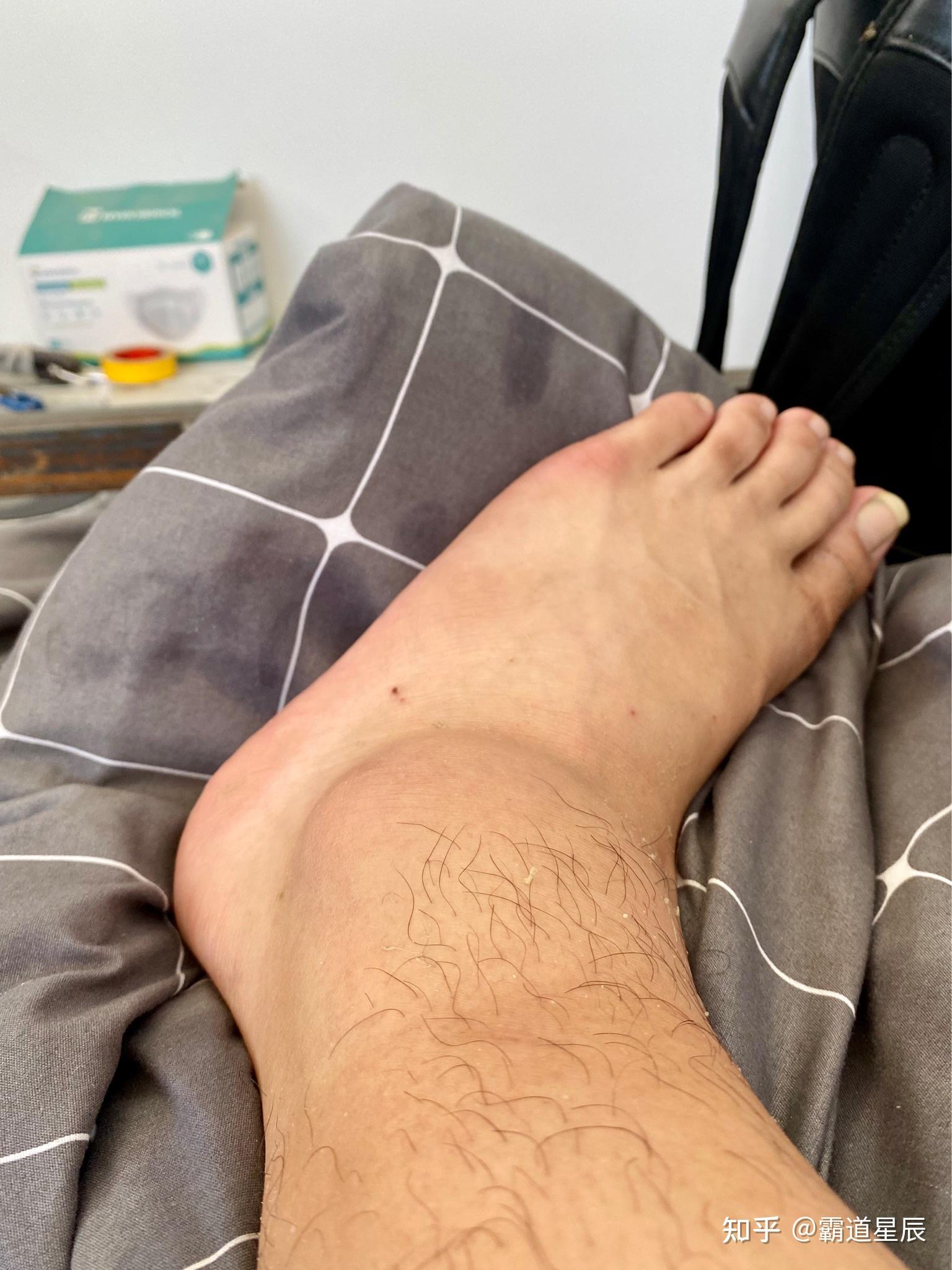 脚崴了快速好起来的最好方法? - 知乎