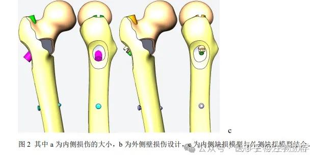 有限元方法分析内外侧缺损对股骨转子间骨折髓内固定术后稳定性的影响 - 知乎
