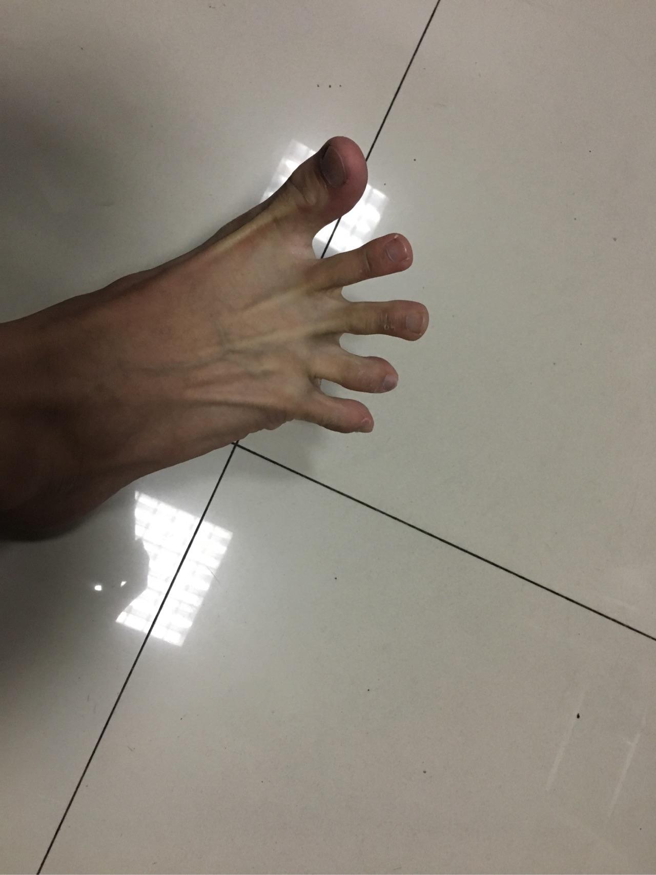 脚趾能否五指张开是基因差异吗？ - 知乎