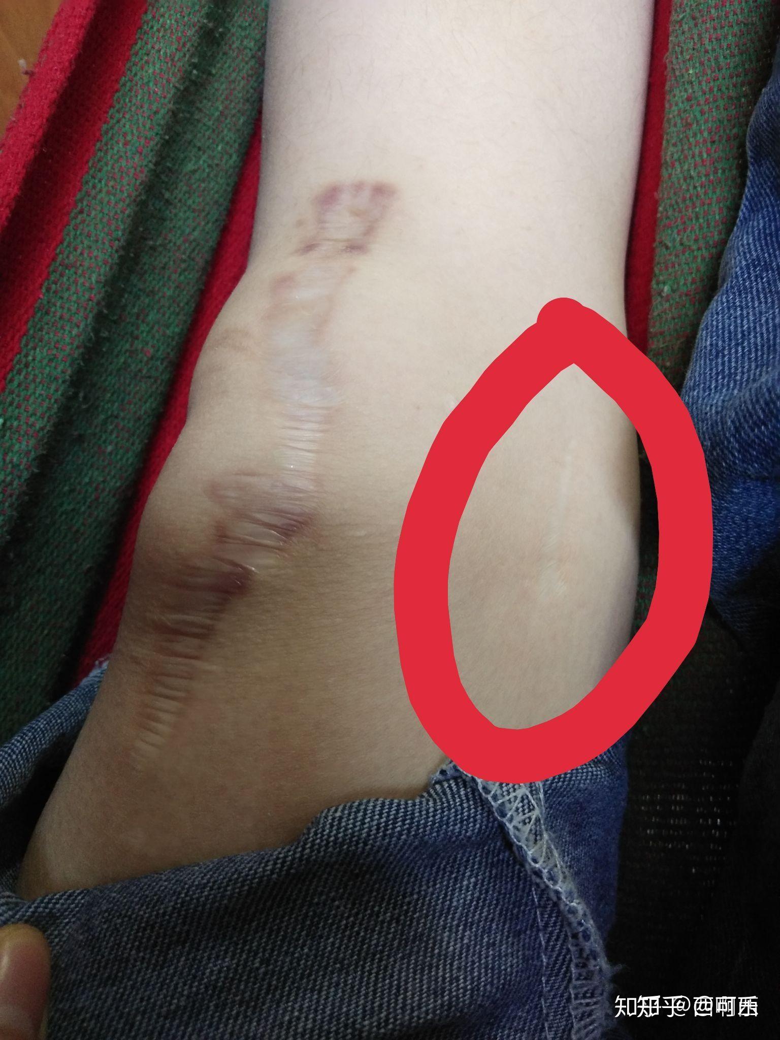 静脉曲张手术后疤痕图图片
