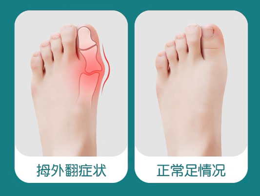 牛江红，得了拇外翻该怎么办? - 知乎