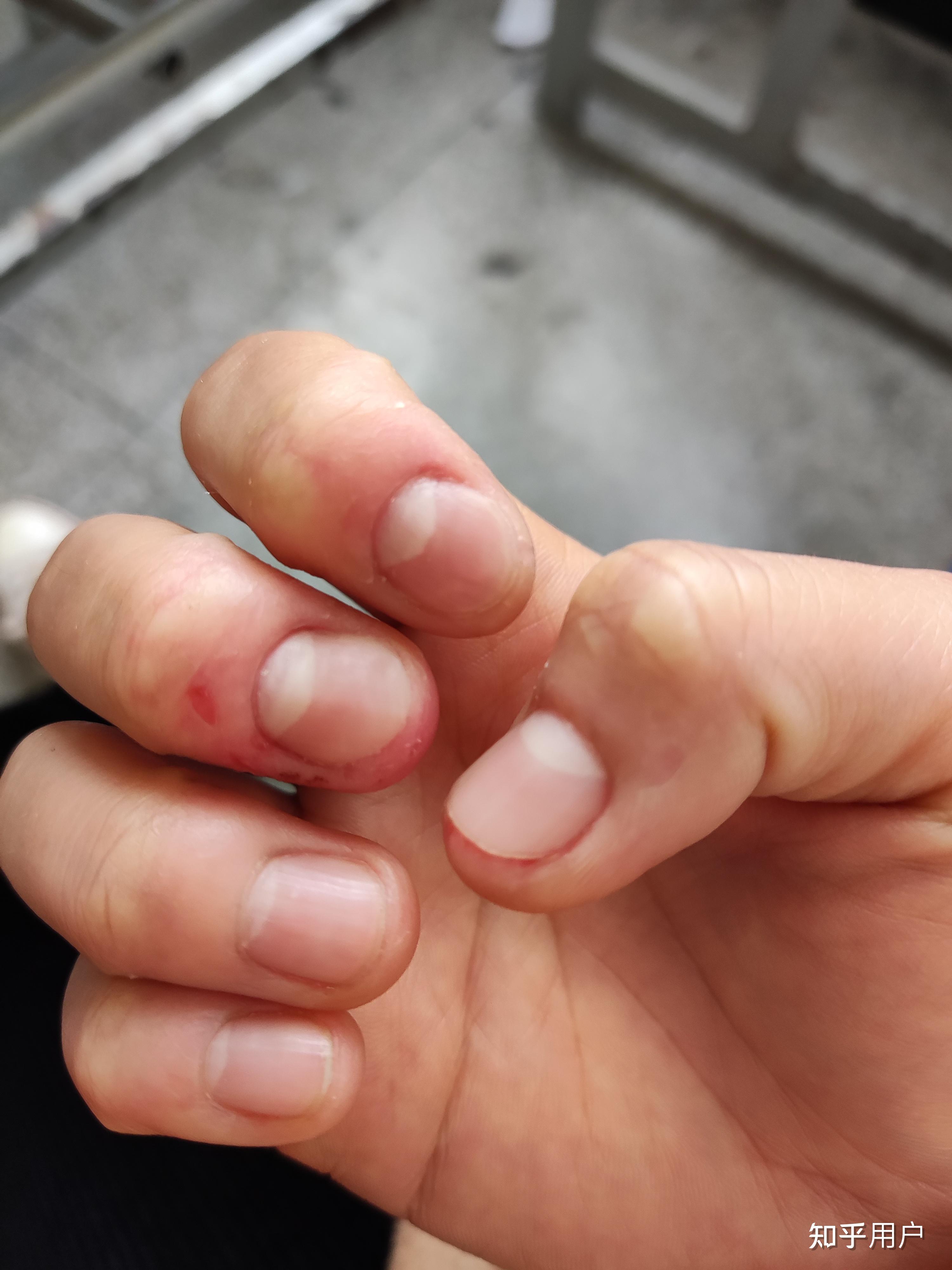 喜欢抠手,都抠破几层皮了,我还是个女孩子,怎么办? - 知乎