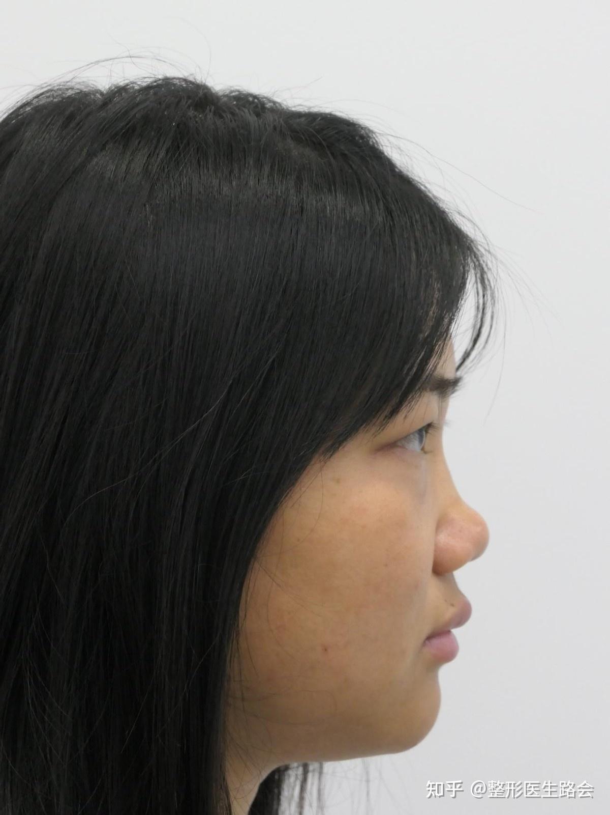 这种鼻子属不属于鞍鼻? - 知乎