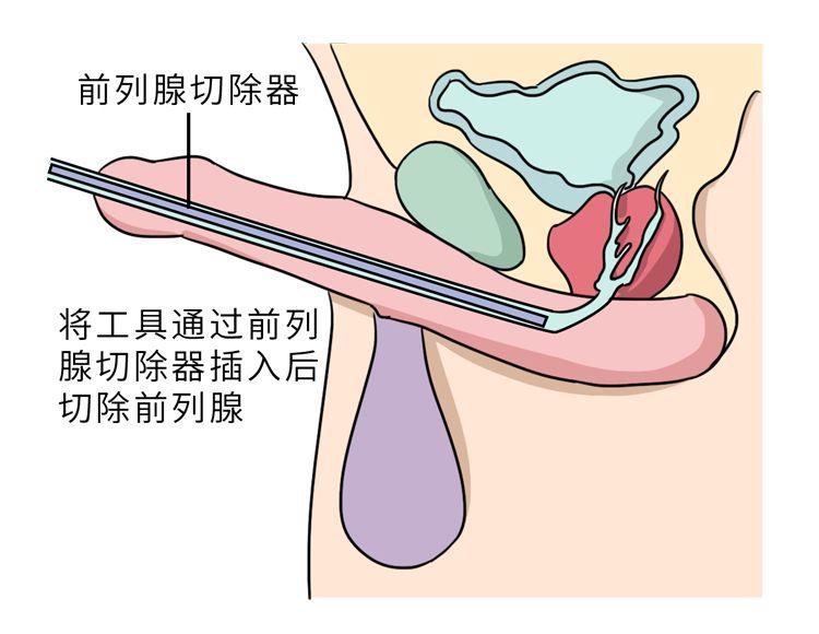 前列腺肥大