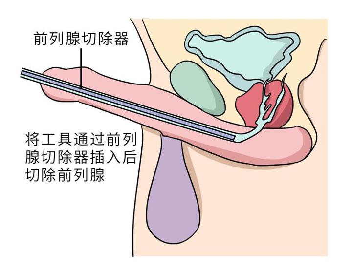 前列腺肥大