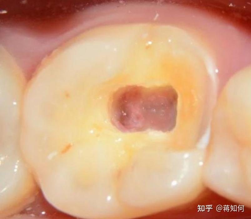 牙神经怎么杀死杀死之后做根管还疼吗