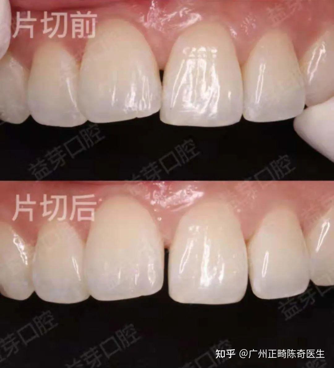 这样的牙齿是选择拔牙还是片切呢?嗷嗷嗷qaq? - 知乎