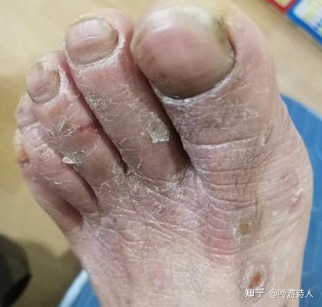 水泡型脚气,是在太痒,抓破了怎么办? - 知乎