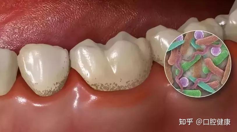 牙周炎，究竟是个什么病？ - 知乎