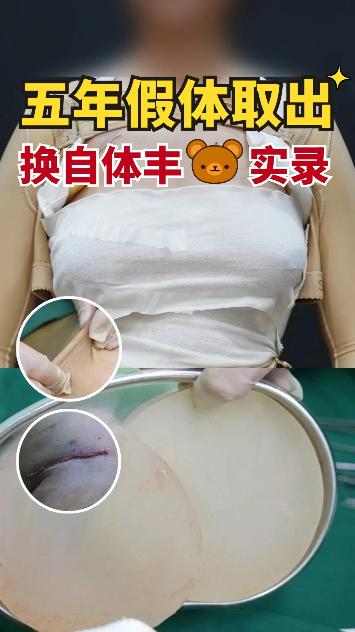 任学会科普:隆胸假体取出后切口在哪里?