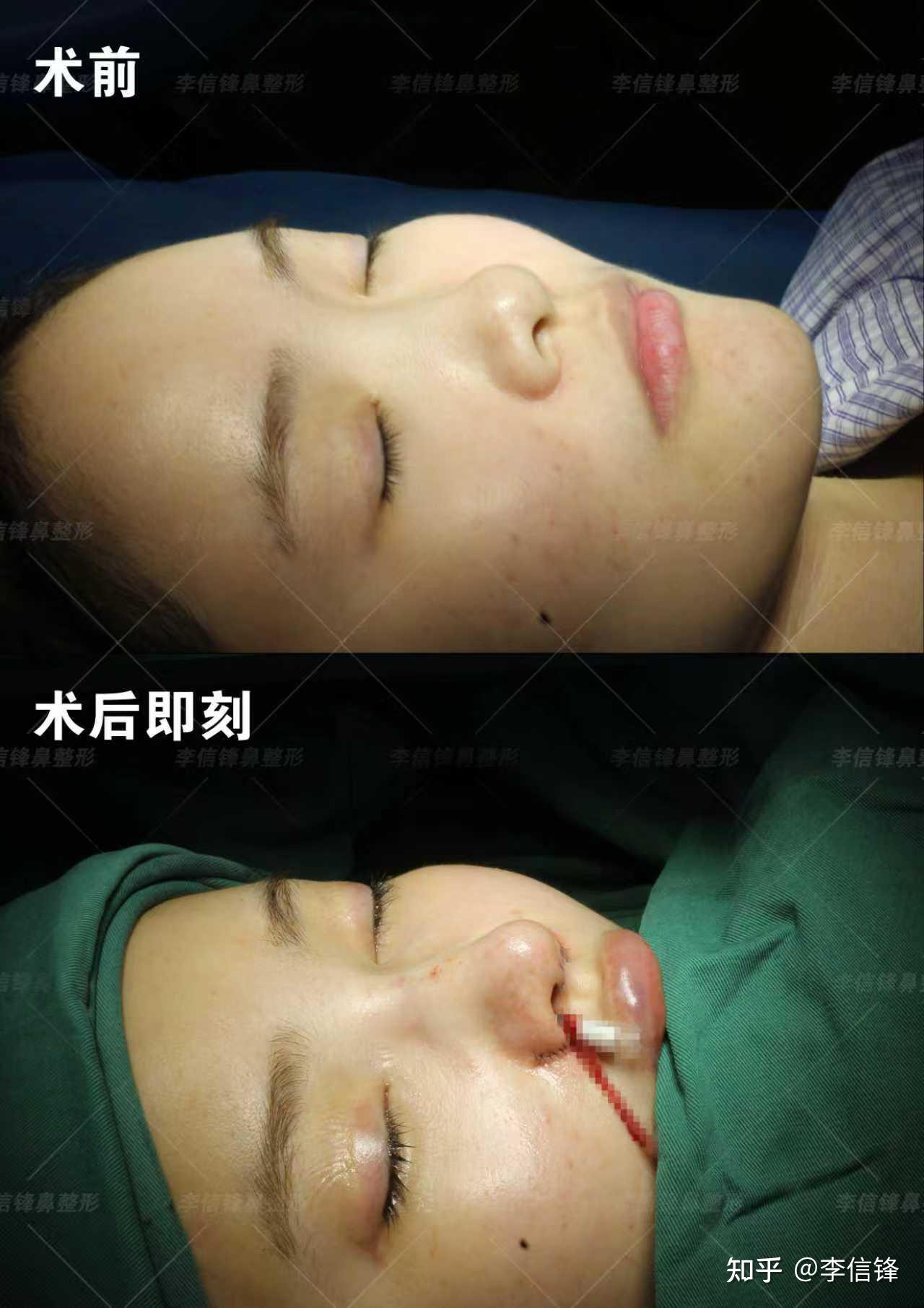 初鼻鼻综合-塌鼻、鼻头圆钝、漏鼻孔,鼻基底凹陷改善,术后即刻对比~ - 知乎