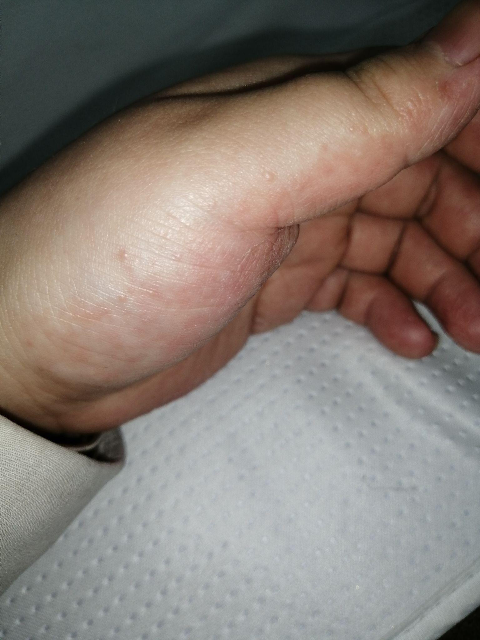 请教知乎的大神有谁知道手上搞上汗疱疹了怎么样才能彻底祛除实在是搞