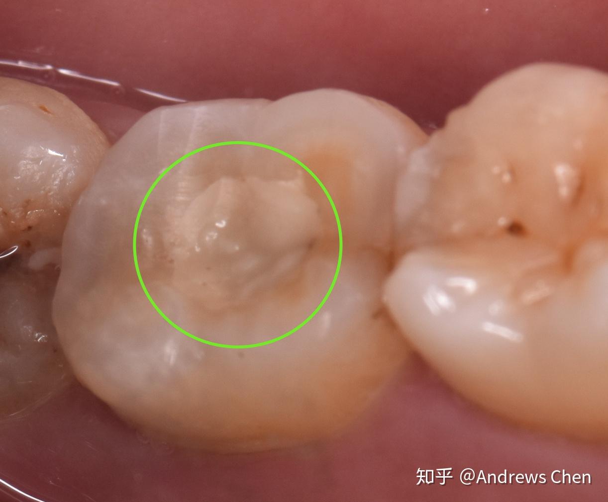 关于补牙假如几年后填充物掉了再次补的话是不是又要磨一次牙会不会磨