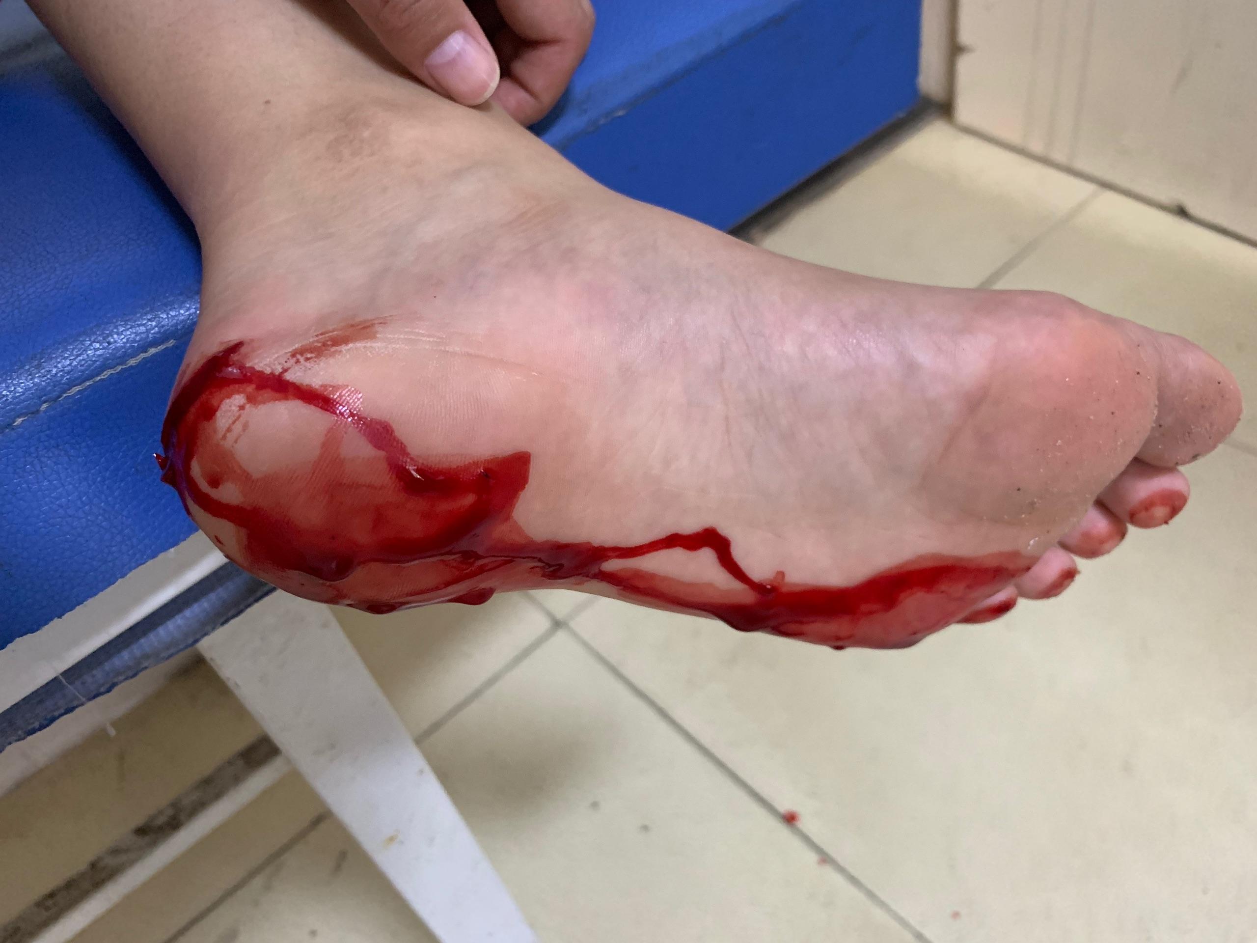 缝针痛还是拆线痛? - 知乎