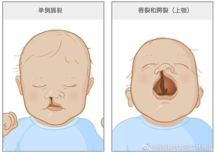 兔唇、唇裂和唇腭裂有什么区别?唇裂整形治疗会不同吗? - 知乎