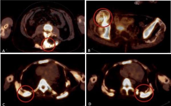FOP中异位骨骼演化的[18F]NaF PET/CT研究 - 知乎