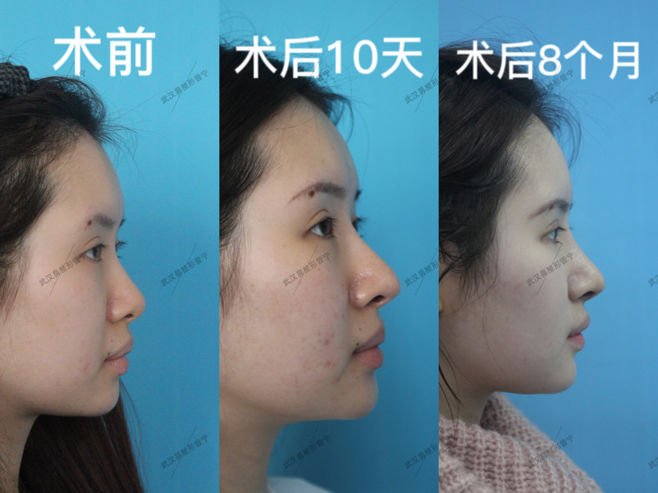 做了鼻综合脸部会有哪些变化? - 知乎