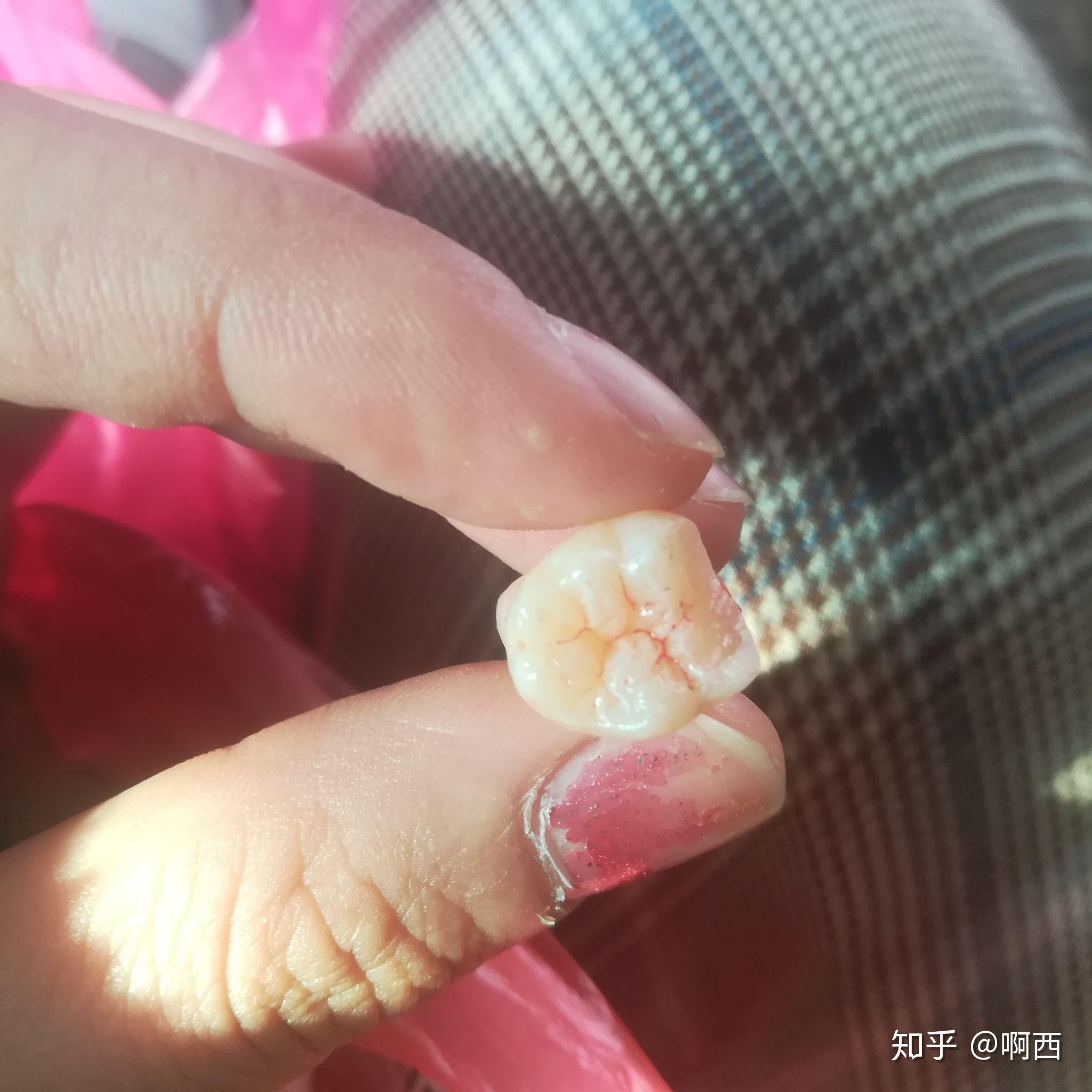 长了四颗阻生智齿是什么样的体验